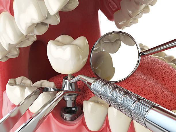 Best Broken or Chipped Tooth Repair in Little Falls, NY